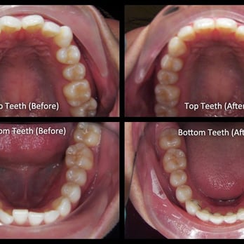 Silicon Valley Orthodontics - My teeth (before and after). Crowding, overbite, and turned canine fixed. Final treatment time - 15 mos. - Orthodontists Near Me - Palo Alto, California Silicon Valley Orthodontics - My teeth (before and after). Crowding, overbite, and turned canine fixed. Final treatment time - 15 mos. - Orthodontists Near Me - Palo Alto, California