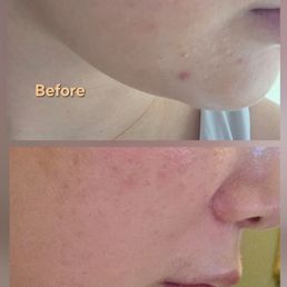 1 month progress, chin is where I usually get new acne. Photo is not altered and no filter was used 1 month progress, chin is where I usually get new acne. Photo is not altered and no filter was used