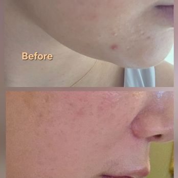 BMB Medical Group - 1 month progress, chin is where I usually get new acne. Photo is not altered and no filter was used - Medical Spas Near Me - Los Angeles, California BMB Medical Group - 1 month progress, chin is where I usually get new acne. Photo is not altered and no filter was used - Medical Spas Near Me - Los Angeles, California