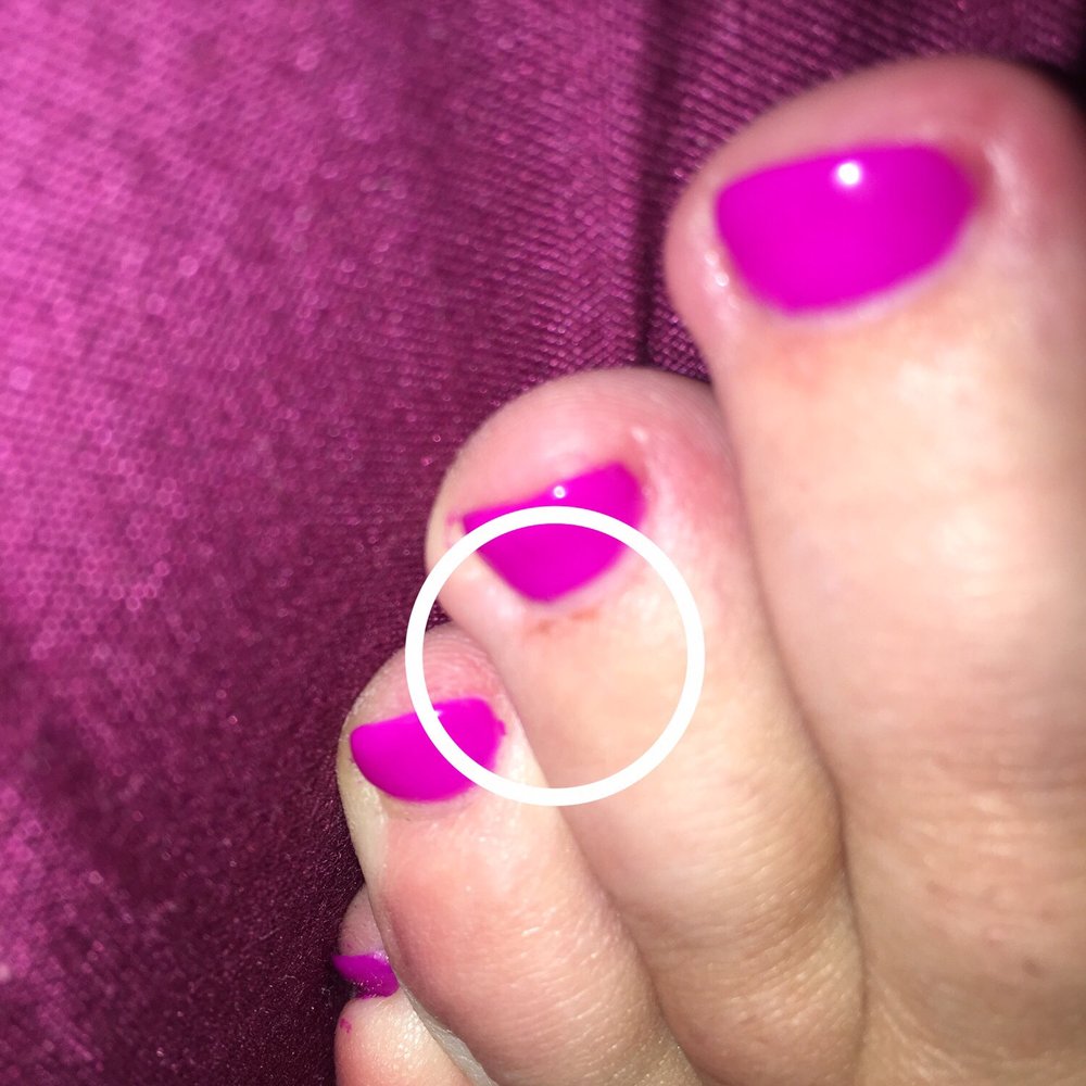 Crescent Nail and Spa - Cut & raw cuticle after bleeding - Nail Salons Near Me - Vancouver, British Columbia Crescent Nail and Spa - Cut & raw cuticle after bleeding - Nail Salons Near Me - Vancouver, British Columbia