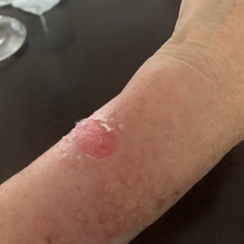 Sharp Memorial Hospital - My Left Arm Removed Blister the skin is still open with pain. - Hospitals Near Me - San Diego, California Sharp Memorial Hospital - My Left Arm Removed Blister the skin is still open with pain. - Hospitals Near Me - San Diego, California