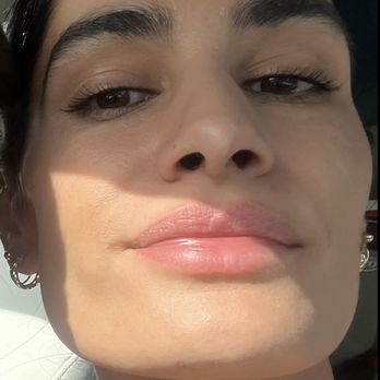 Ahava Medspa - In love with my natural results!!!! - Medical Spas Near Me - Rancho Cucamonga, California