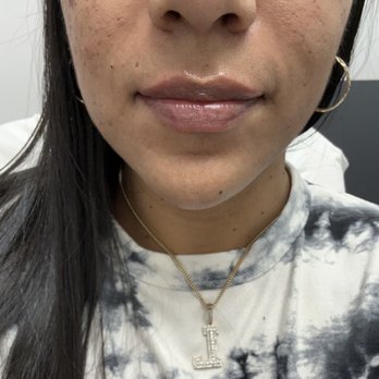 LaserAway - Lip fillers - Tattoo Removal Near Me - San Francisco, California LaserAway - Lip fillers - Tattoo Removal Near Me - San Francisco, California