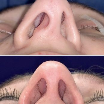 Saba Plastic Surgery - Close rhinoplasty performed for nasal blockage & crooked nostrils. She has open nasal passages & improved nostril symmetry 6mos after. - Plastic Surgeons Near Me - Scottsdale, Arizona Saba Plastic Surgery - Close rhinoplasty performed for nasal blockage & crooked nostrils. She has open nasal passages & improved nostril symmetry 6mos after. - Plastic Surgeons Near Me - Scottsdale, Arizona