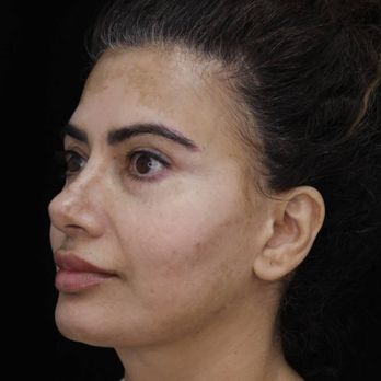 Shine MD - Skin Care Near Me - Vancouver, British Columbia