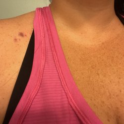 Countryside Surgery Center - Bruise from nurse