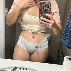 Otto Placik | Chicago Plastic Surgeon - This was 3 days post op and feeling great!