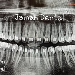 Silicon Valley Dental Center - All wisdom teeth REMOVAL under sedation with bone grafting is a one-time deal that you don't have to worry about for the rest of your life