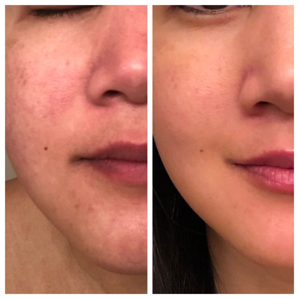 Serenity Skin Spa - Total transformation in 4 treatments! - Skin Care Near Me - Newport Beach, California Serenity Skin Spa - Total transformation in 4 treatments! - Skin Care Near Me - Newport Beach, California