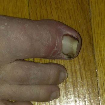 Delux Nail and Spa - Infected toe after being treated for a week of Rx drugs and cream. - Waxing Near Me - San Antonio, Texas