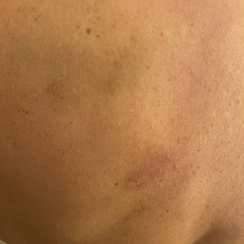 Massage Zone - Bruises on my back from Masseuse after a Reflexoloy massage - Massage Near Me - Katy, Texas