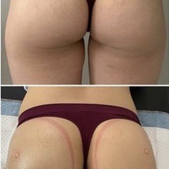 Edge Body Sculpting - before and after. booty enhancement session! - Body Contouring Near Me
