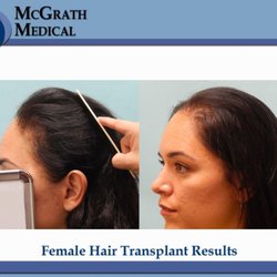 McGrath Medical - Hairline lowering for women