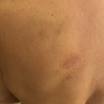 Massage Zone - Bruises on my back after receiving Reflexoloy massage from Masseuse - Massage Near Me - Katy, Texas