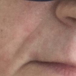 Threading Station - My splotchy, irritated skin the next day.