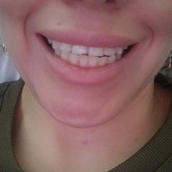 Celebrate Dental & Braces - Completely moved my bottom teeth look at the middle line on the bottom