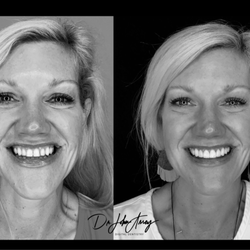 Assey Dental Associates - Patient before and after - Digital Smile Design  at Assey Dental Associates in Mount Pleasant, SC