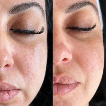 Brea Medical Aesthetics - Morpheus 8 does wonders! - Medical Spas Near Me - Brea, California Brea Medical Aesthetics - Morpheus 8 does wonders! - Medical Spas Near Me - Brea, California