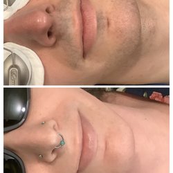 Luxe Laser - B/A Laser hair removal