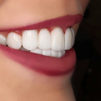Creating Smiles Dental - After - Side View - General Dentistry Near Me - St. Petersburg, Florida Creating Smiles Dental - After - Side View - General Dentistry Near Me - St. Petersburg, Florida