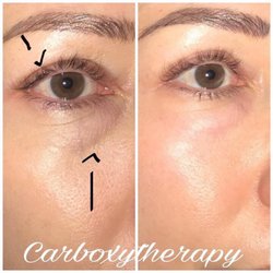Rejuline Skin and Body - Carboxytherapy