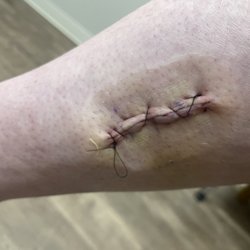 Medical City Denton Center for Neuroscience - Post surgery #2, 6 months post-op from surgery #1.