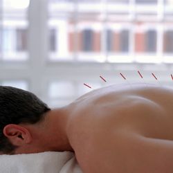 Precision Physical Therapy - Dry Needling