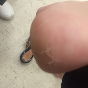 Dream Nails - One of 2 bad heals after a pedicure at dream nails - Nail Salons Near Me - Rochester, New York