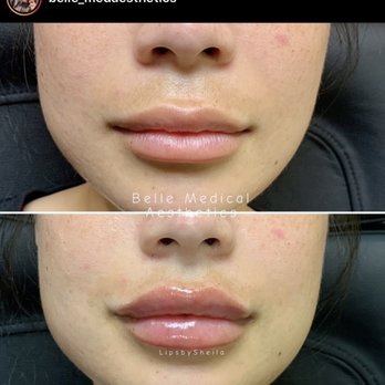 Belle Medical Aesthetics - Lips - Skin Care Near Me - Bellingham, Washington