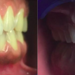 NÜVA Smile - Before & After at NÜVA Smile | East Brunswick, NJ