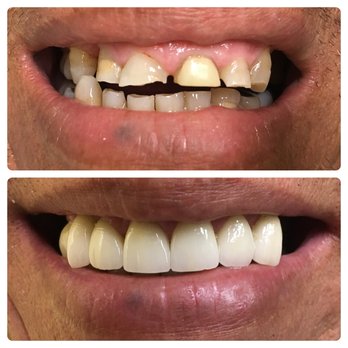 Care One Dental - Delray Beach - Giving the patients something to smile about! A beautiful full mouth rehabilitation from Care One Dental. - General Dentistry Near Me - Delray Beach, Florida Care One Dental - Delray Beach - Giving the patients something to smile about! A beautiful full mouth rehabilitation from Care One Dental. - General Dentistry Near Me - Delray Beach, Florida