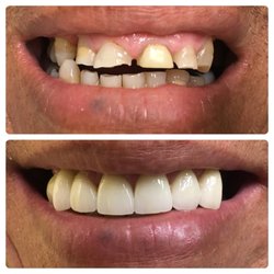 Giving the patients something to smile about! A beautiful full mouth rehabilitation from Care One Dental.