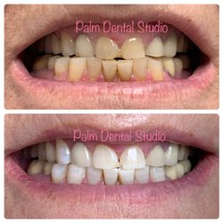 Palm Dental Studio - Smile makeover