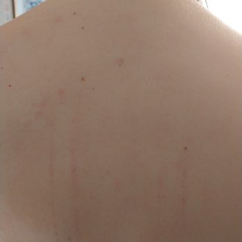 Monterey foot SPA - The scratches left by my painful massage. The bruises are still forming and didn't photograph well. - Massage Near Me - Monterey, California