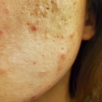 Design Us Clinic - Breakout/acne/infection - Skin Care Near Me - Los Angeles, California