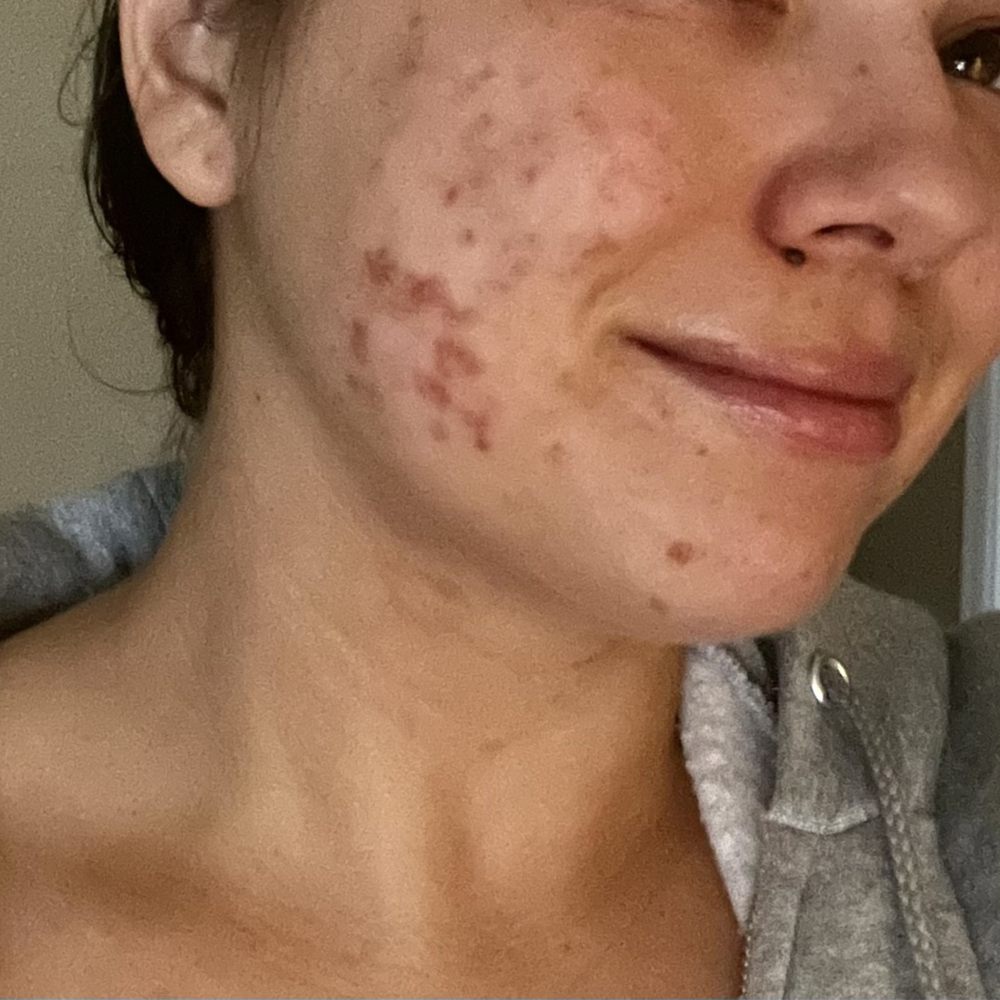 Massage Envy - Marks on face from facial - Massage Near Me - Tucson, Arizona Massage Envy - Marks on face from facial - Massage Near Me - Tucson, Arizona