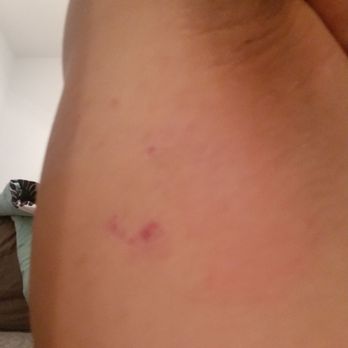 Sugaring NYC - Chicago - Bruises from the underarm sugar waxing. Extreme pain! - Sugaring Near Me - Chicago, Illinois