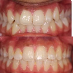 Toothworks of Bakersfield - 6 month Invisalign treatment with Dr. B !