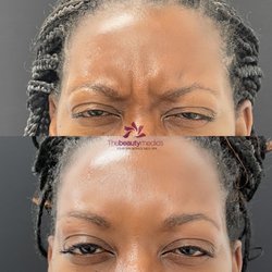 The Beauty Medics - Botox for frown lines!