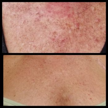 Team Beauti - Hyperpigmentation and sun damage before and after results after 1 chemical peel treatment. - Makeup Artists Near Me - West Palm Beach, Florida Team Beauti - Hyperpigmentation and sun damage before and after results after 1 chemical peel treatment. - Makeup Artists Near Me - West Palm Beach, Florida