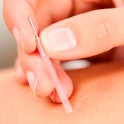 AcuRenew - Acupuncture