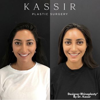 Ramtin Kassir, MD - After Designer Rhinoplasty® - Cosmetic Surgeons Near Me - Ridgewood, New Jersey Ramtin Kassir, MD - After Designer Rhinoplasty® - Cosmetic Surgeons Near Me - Ridgewood, New Jersey