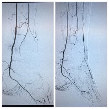 Miami Vascular Surgery - Revascularisation of anterior tibial artery. Treatment for Foot & Toe ulcers is accomplished by artherectomy. - Vascular Medicine Near Me - South Miami, Florida Miami Vascular Surgery - Revascularisation of anterior tibial artery. Treatment for Foot & Toe ulcers is accomplished by artherectomy. - Vascular Medicine Near Me - South Miami, Florida