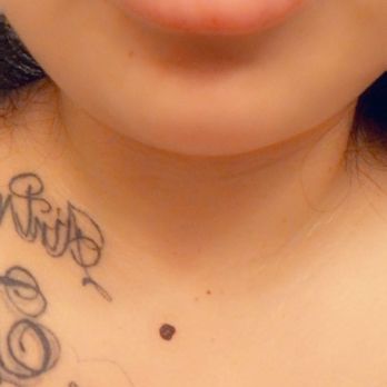 The Image Center - After lip fillers - Plastic Surgeons Near Me - Irvine, California The Image Center - After lip fillers - Plastic Surgeons Near Me - Irvine, California