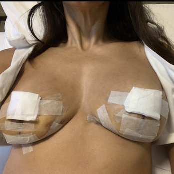 Andrew P Amunatequi, MD - 2nd post-op.  These are not small or tight. - Cosmetic Surgeons Near Me - Miami, Florida