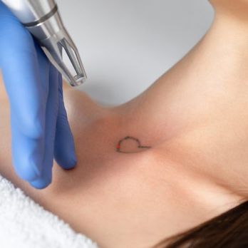 Bella Spa - Tattoo Removal - Tattoo Removal Near Me Bella Spa - Tattoo Removal - Tattoo Removal Near Me