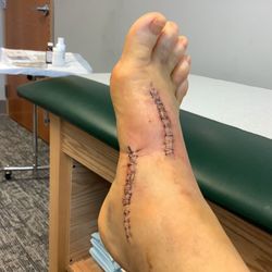 Great Lakes Orthopaedic Center - This was the first procedure, 2 weeks and getting the staples out. He did 3 surgeries that time you can't see the other incisions.