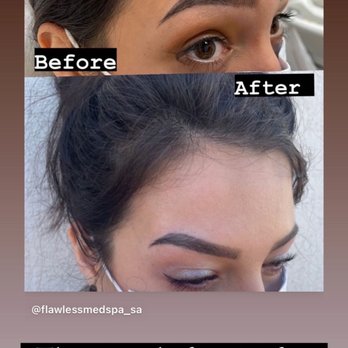 Flawless Laser & Med Spa - Laser Hair Removal Near Me - San Antonio, Texas