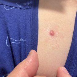 Sid Danesh, MD - 5 months post mole removal. Not healing as I expected.