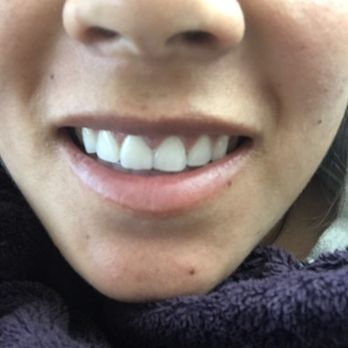 Veronica Avalos, DDS - My new veneer - General Dentistry Near Me - South San Francisco, California Veronica Avalos, DDS - My new veneer - General Dentistry Near Me - South San Francisco, California